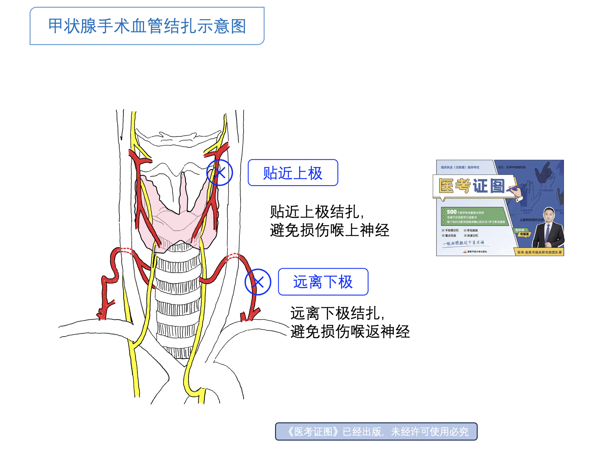 甲亢手术血管结扎.png